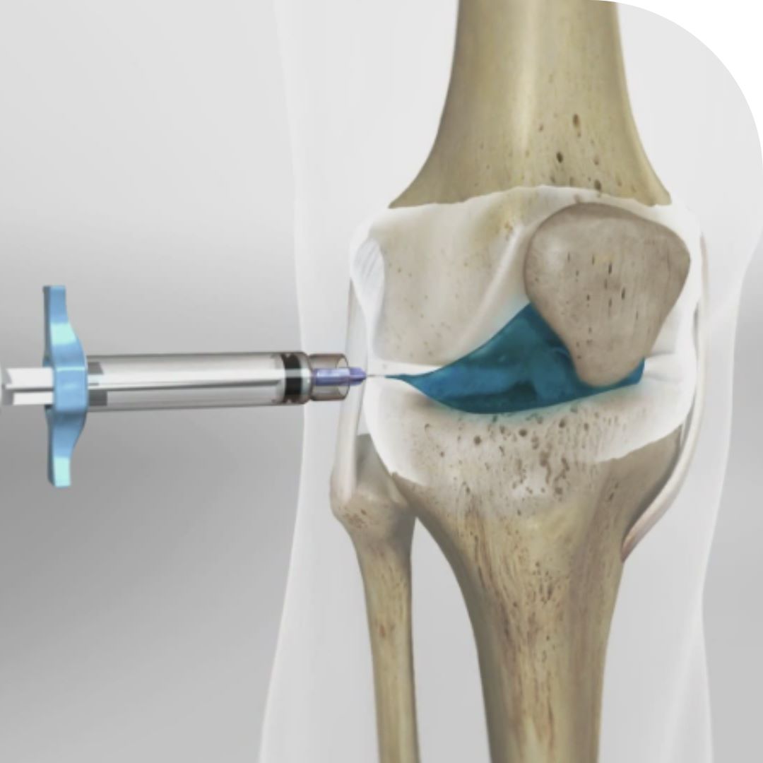 KNEE PAIN TREATMENT WITHOUT SURGERY